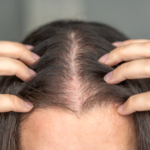 Thinning Hairline