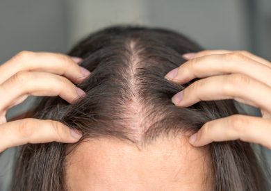 Thinning Hairline