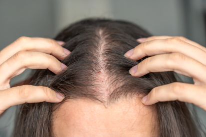 Thinning Hairline