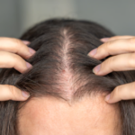 Hairline