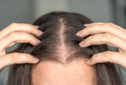 Hairline