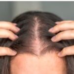 Thinning Hairline