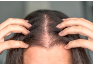 Thinning Hairline