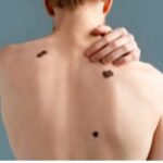 Tingling Moles Early