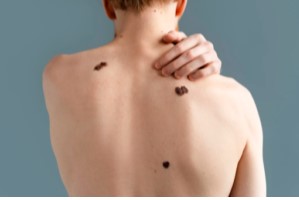 Tingling Moles Early